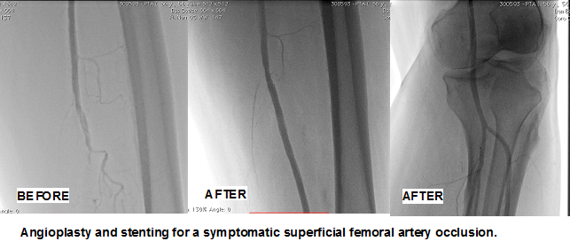 Spinal AVM in Hyderabad