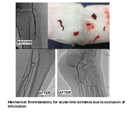 Spinal Angiogram in Hyderabad
