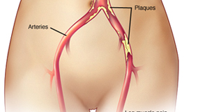 Peripheral Vascular disease Treatment in Hyderabad